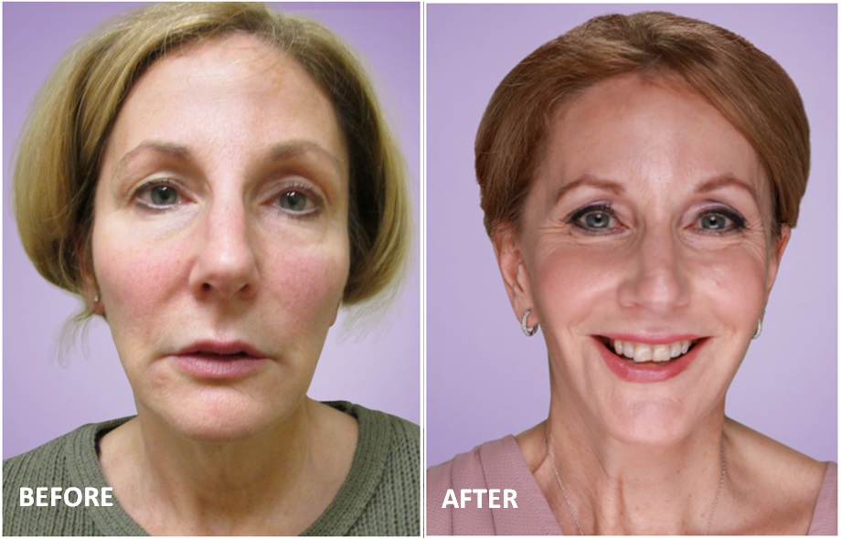 Before/After Pictures - Juvilee Facial Rejuvenation