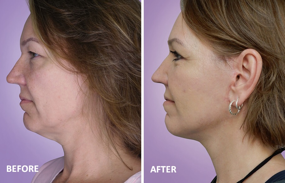 Before/After Pictures - Juvilee Facial Rejuvenation